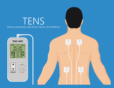 경피적 신경자극 치료(TENS)