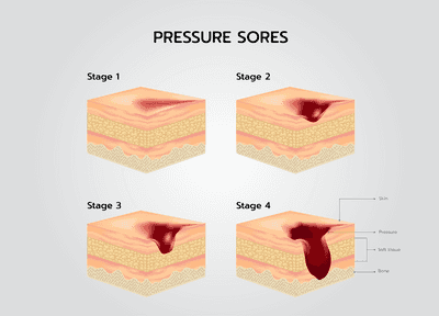 욕창 환자 관리